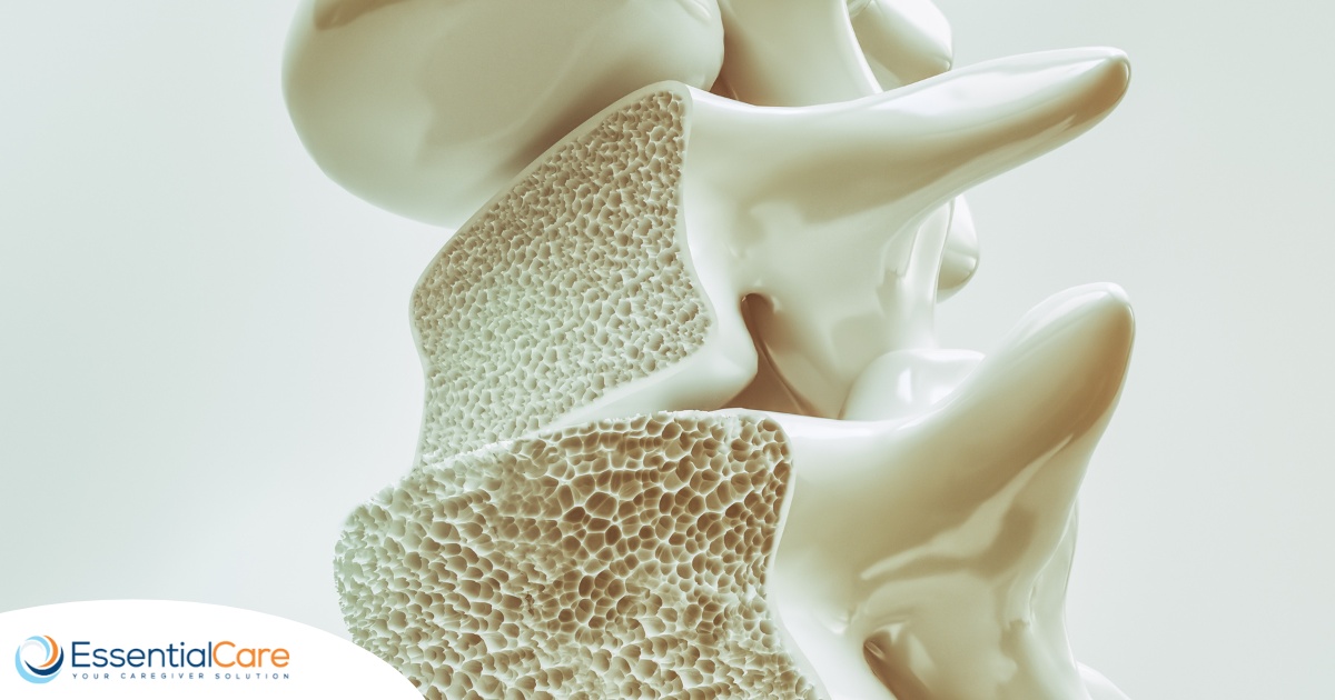 An image of a spine with the inside exposed represents osteoporosis.